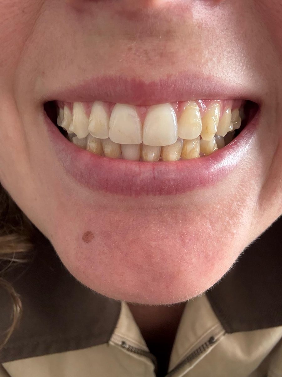 Sorriso da mesma paciente depois do tratamento com Invisalign